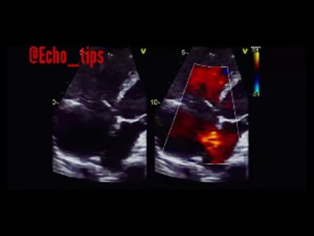 11. Cas d'échocardiographie - Qu'est-ce que vous voyez ?
