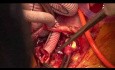 Remplacement total de l'arc aortique avec une trompe d'éléphant stentée