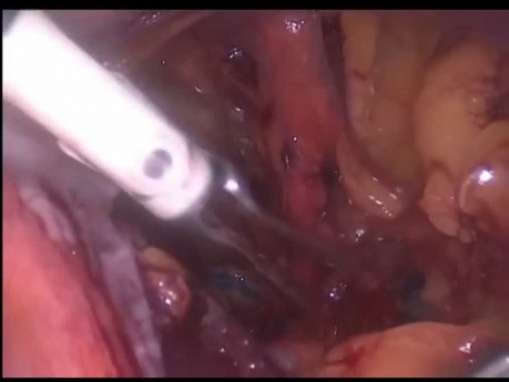 Dissection laparoscopique des ganglions lymphatiques pelviens