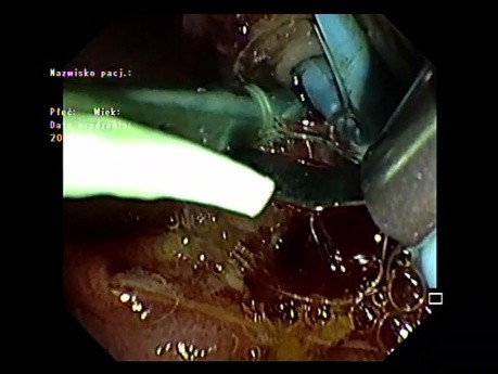 Ampullectomie (Partie3)