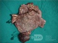 Le tumeur mixte mésodermique maligne. L' utérus.    3
