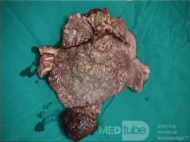 Le tumeur mixte mésodermique maligne. L' utérus.    3