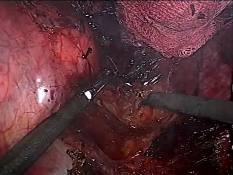 Surrénalectomie laparoscopique droite pour une tumeur géante (14 cm)