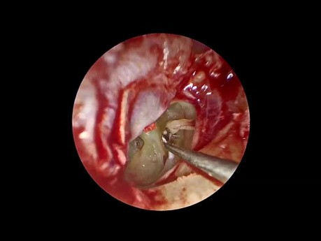 Stapédotomie Endoscopique avec Perforateur Manuel