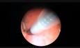 Placement Essure au bureau
