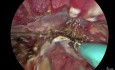 Hystérectomie vNOTES pour Adénomyose
