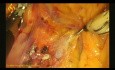 Lymphadénectomie laparoscopique pour cancer du côlon droit