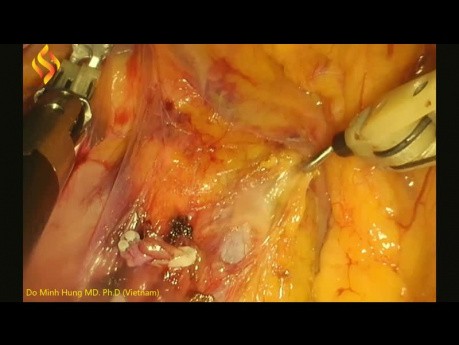 Lymphadénectomie laparoscopique pour cancer du côlon droit