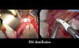 Exérèse totale du mésorectum  - laparoscopie et chirurgie ouvert