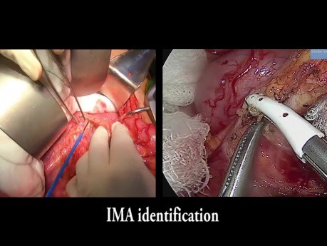 Exérèse totale du mésorectum  - laparoscopie et chirurgie ouvert