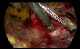Réparation de Hernie par voie TEP avec Prothèse Auto-Fixante (vidéo complète, seuls les temps morts supprimés)
