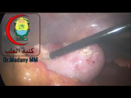 Aspiration ou Traction par Fil de Suture de la VB