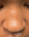 Pli nasal de l'allergique
