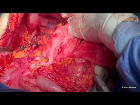 Chirurgie Cytoréductive du Cancer de l'Ovaire. Version Non Editée: Partie II Abdomen Moyen