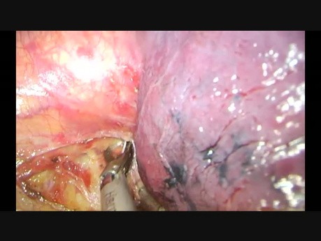 Lymphadénectomie totale des ganglions lymphatiques de localisation paratrachéale, aorto-pulmonaires en utilisant la méthode CTVA-U / VATS uniportal