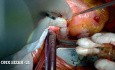 Remplacement de la valve aortique et mitrale pour l'endocardite infectieuse de la valve native