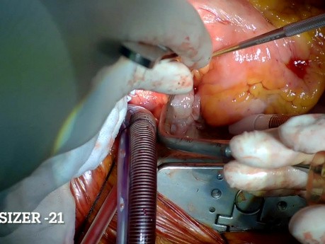 Remplacement de la valve aortique et mitrale pour l'endocardite infectieuse de la valve native