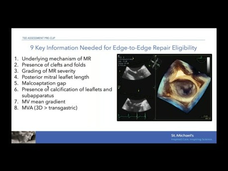 Évaluation Echocardiographique de la Réparation Mitrale Bord à Bord