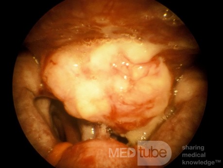 Carcinome du nasopharynx