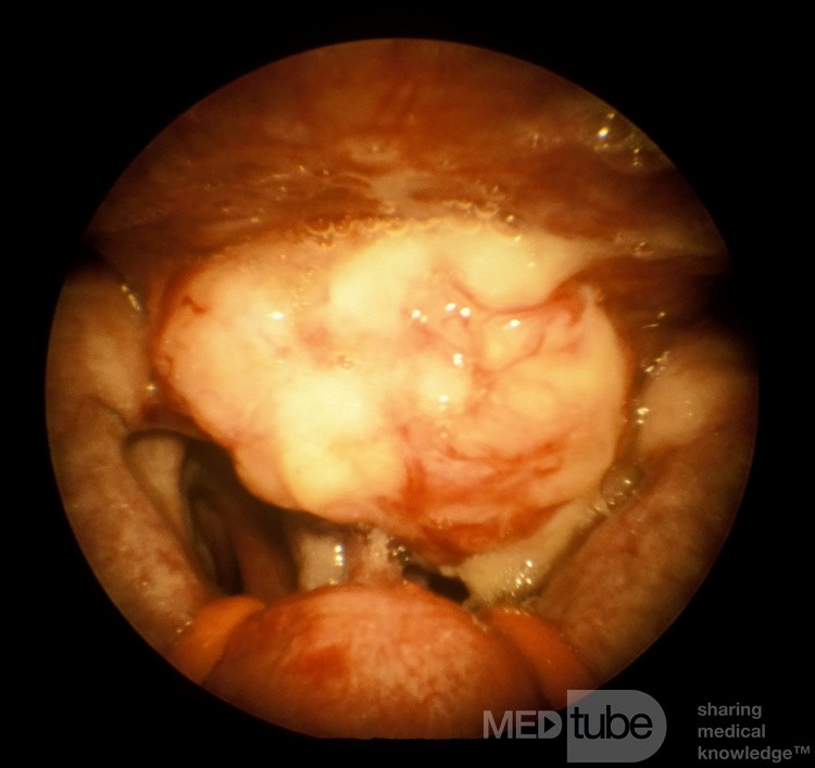 Carcinome du nasopharynx