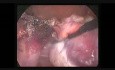 Hysterctomie par coelioscopie sur un gros uterus polymyomateux