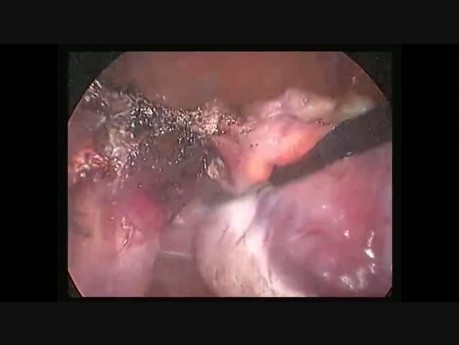 Hysterctomie par coelioscopie sur un gros uterus polymyomateux