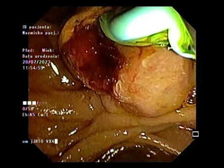 Adénocarcinome Ampullaire Diagnostiqué avec Echo-endoscopie et CPRE