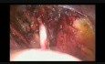 Lymphadénectomie pelvienne laparoscopique