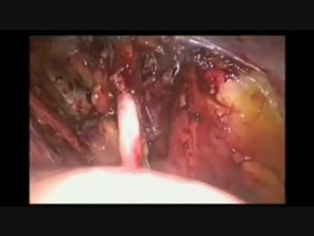 Lymphadénectomie pelvienne laparoscopique