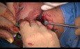 Traitement Chirurgical Intra+Extracapsulaire Condyle Mandibulaire Double Fracture (prof. M. Maglione, dr Roberto Rizzo Trieste University Italy)