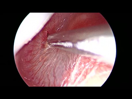 Insertion endoscopique d'un œillet pour l'otite moyenne gauche avec épanchement