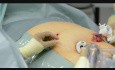 Cathéter pré-péritonéal pour le contrôle de la douleur après une intervention laparoscopique