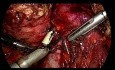 Duodénopancréatectomie céphalique (DPC, opération de Whipple) pour cancer de l'ampoule hépatopancréatique - cœlioscopie