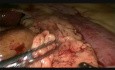 Gastrectomie distale par voie laparoscopique