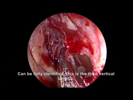 Chirurgie Endoscopique Complète des Sinus pour Sinusite Chronique avec Polypose Nasale