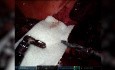 Technique Chirurgicale pour l'Utilisation de TachoSil® en Chirurgie Robotique Pour une Hémostase et une Etanchéité Suffisantes lors d'une Hémi-Hépatectomie Gauche