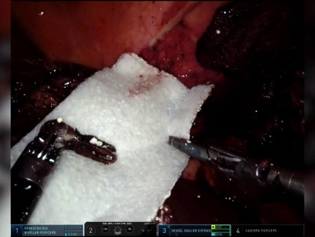 Technique Chirurgicale pour l'Utilisation de TachoSil® en Chirurgie Robotique Pour une Hémostase et une Etanchéité Suffisantes lors d'une Hémi-Hépatectomie Gauche