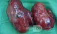 Goitre multinodulaire toxique- thyroïdectomie totale 1