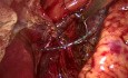 Hernie Hiatale Axiale - Reflux Gastro-Oesophagien