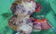 Occlusion de l'intestin grêle au cours d'evolution d'un lymphome - 2