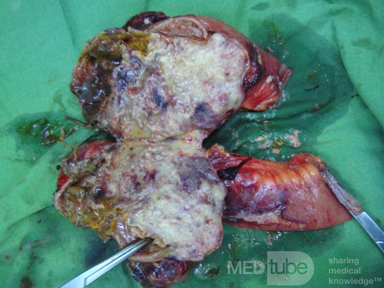 Occlusion de l'intestin grêle au cours d'evolution d'un lymphome - 2