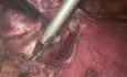 Chirurgie thoracoscopique vidéo-assistée - ablation du thymome