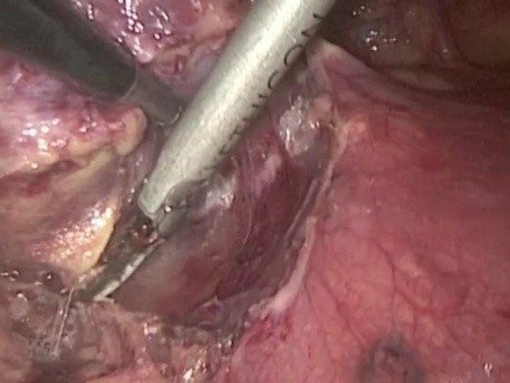 Chirurgie thoracoscopique vidéo-assistée - ablation du thymome
