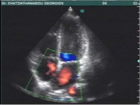Quiz de cardiologie n° 3 - l'ECG et l'échocardiogramme d'un patient atteint d'une cardiopathie congénitale