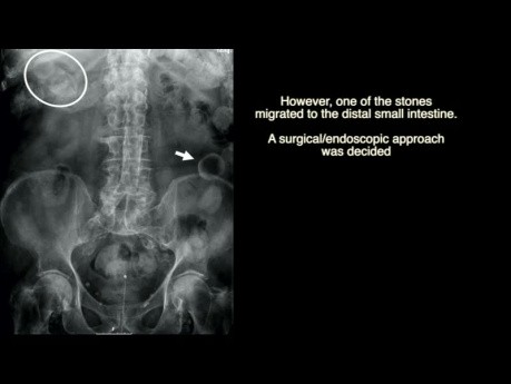 Syndrome de Bouveret