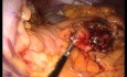 Pancréatectomie Distale et Splénectomie Laparo-endoscopique à site unique (LESS)
