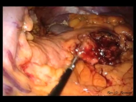 Pancréatectomie Distale et Splénectomie Laparo-endoscopique à site unique (LESS)