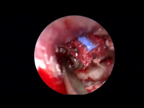 Tympanoplastie du Fascia Temporal