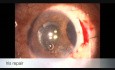 Traumatisme oculaire fermé, phacotrabéculectomie et réparation de l'iris