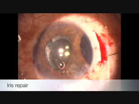 Traumatisme oculaire fermé, phacotrabéculectomie et réparation de l'iris